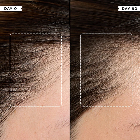 Image 1 - A before and after comparison image shows a persons hairline with sparser hair on the left and denser hair on the right, labeled DAY 0 and DAY 90. Image 2 - A dark green bottle of Philip Kingsley Density Preserving Scalp Drops with a white dropper is shown next to text stating 81% noticed HAIR LOSS was REDUCED after 2 months*, 80% noticed an IMPROVEMENT in HAIR GROWTH after 2 months*, *INDEPENDENT USER TRIALS. Image 3 - A dark green bottle of Philip Kingsley Density Preserving Scalp Drops with a white dropper cap and label reading Philip Kingsley Density Preserving Scalp Drops Sérum Protecteur Pour Cuir Chevelu Reduces hair fall and preserves density Réduit la chute de cheveux et préserve la densité capillaire 30ml 1.01 FL. OZ., with several clear liquid drops next to it, accompanied by a list of Key Benefits: Stimulates and protects follicles to preserve hair density, Creates an optimal scalp environment for healthy hair growth, and Helps reduce hair fall and preserve the hair you have. Image 4 - A hand applies a liquid from a dropper onto a scalp with reddish-brown hair, with the text Trichologist Tip Consistency leads to results. Apply to the scalp DAILY to help maintain follicle health and reduce shedding over time. Image 5 - A Philip Kingsley Density Stimulating Scalp Mask tube is shown with a swirl of white product, alongside text that reads 91% reported their scalp felt NOURISHED*, 91% reported a POSITIVE EFFECT on the health and condition of their scalp*, 86% reported roots looked HEALTHY*, *INDEPENDENT USER TRIALS, PHILIP KINGSLEY DENSITY STIMULATING SCALP MASK MASQUE STIMULANT POUR CUIR CHEVELU Energises and balances the scalp Stimule et equilibre le cuir chevelu 75ml 2.53 fl oz. Image 6 - A hand applies a white scalp mask from a green and white tube with a nozzle onto a persons brown hair, with text beside it reading Effortless to apply, my scalp and roots look and feel so REFRESHED and HEALTHY already. BLIND USER PANEL COMMENT. The product tube label displays PHILIP KINGSLEY DENSITY STIMULATING SCALP MASK MASQUE STIMULANT POUR CHEVELU energises and advances the scalp formule et equilibre le cuir chevelu 75ml 2.53 fl oz. Image 7 - A dark green bottle of Philip Kingsley Density Stimulating Scalp Toner with a white pointed applicator cap stands on a white surface, next to text detailing user trial results which state 94% reported their scalp felt REFRESHED*, 92% reported their scalp felt HEALTHIER*, and 91% liked the COOLING SENSATION on their scalp*, followed by *INDEPENDENT USER TRIALS; the bottle label further reads TONIQUE STIMULANT POUR CUIR CHEVELU, Invigorates and refreshes the scalp, Vivifie et rafraîchit le cuir chevelu, 150ml 5.07 fl.oz. Image 8 - A hand holds a dark green bottle of Philip Kingsley Density Stimulating Scalp Toner with a white pointed cap, next to a list of benefits: KEY BENEFITS Stimulating scalp energiser, Targets imbalances for a healthy scalp environment, Supports healthy hair growth, Water-based, fragrance-free formula, Residue-free.