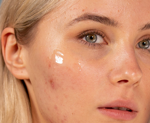 Ameliorate Imperfections et peau grasse